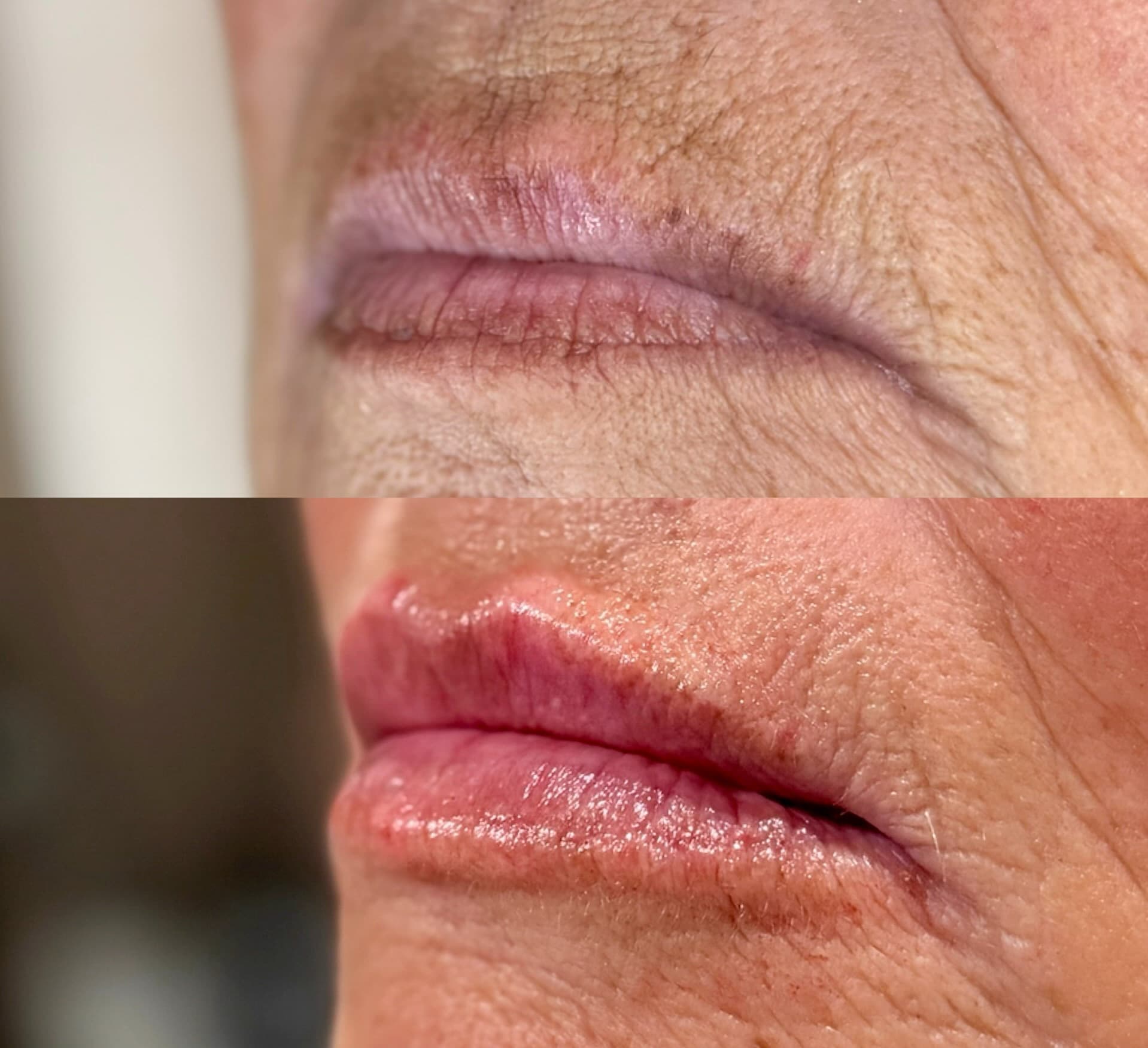 Lip Filler before and after
