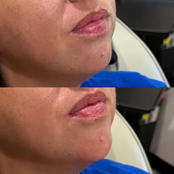 Before and after: Chin and jaw at an angle, before on top and after below, chin filler