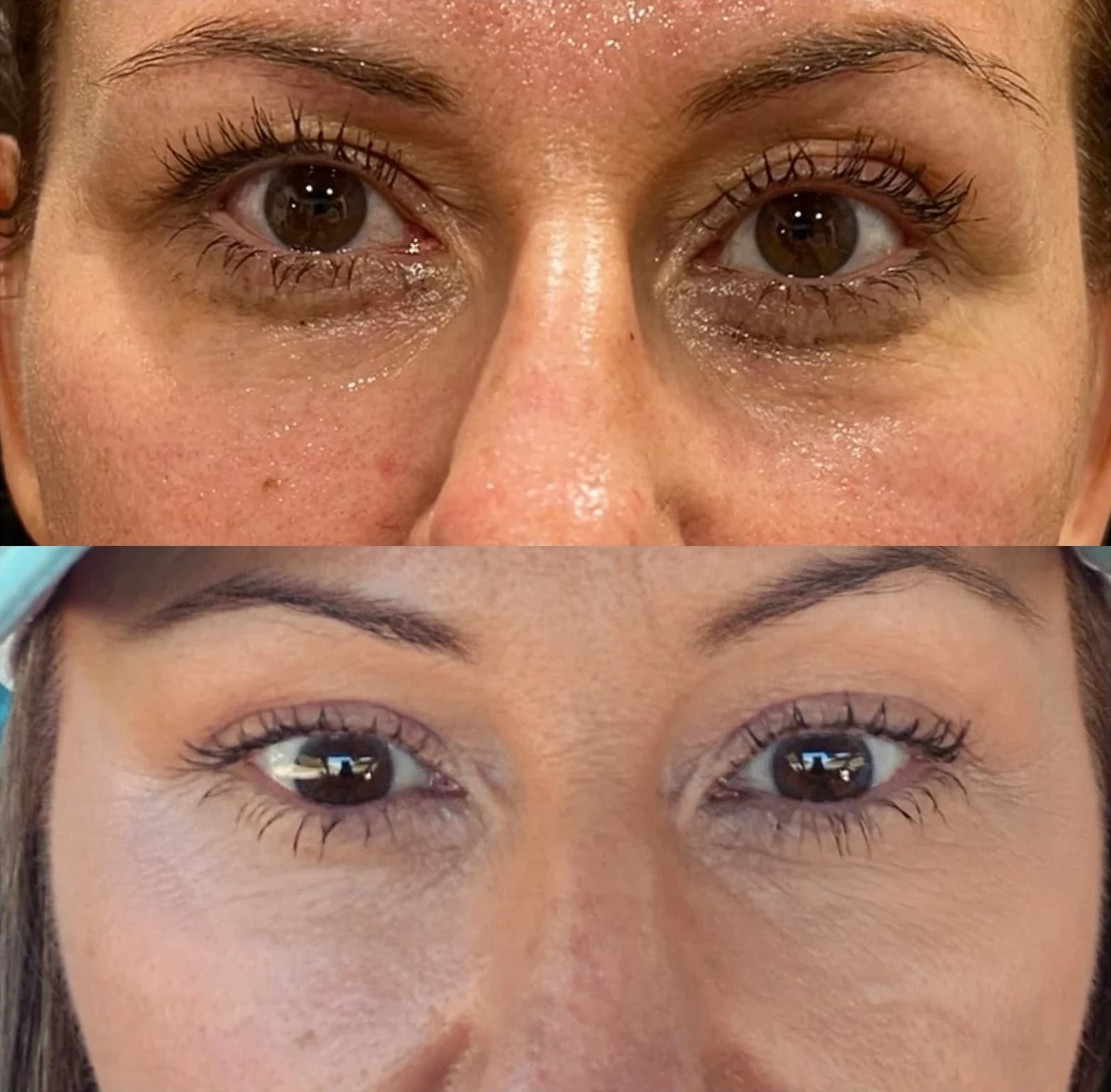 Before and after: Derma PRP under the eyes at Just Face It