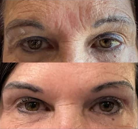 Before and after: Eyes and brows, before on top and after below, laser and tox