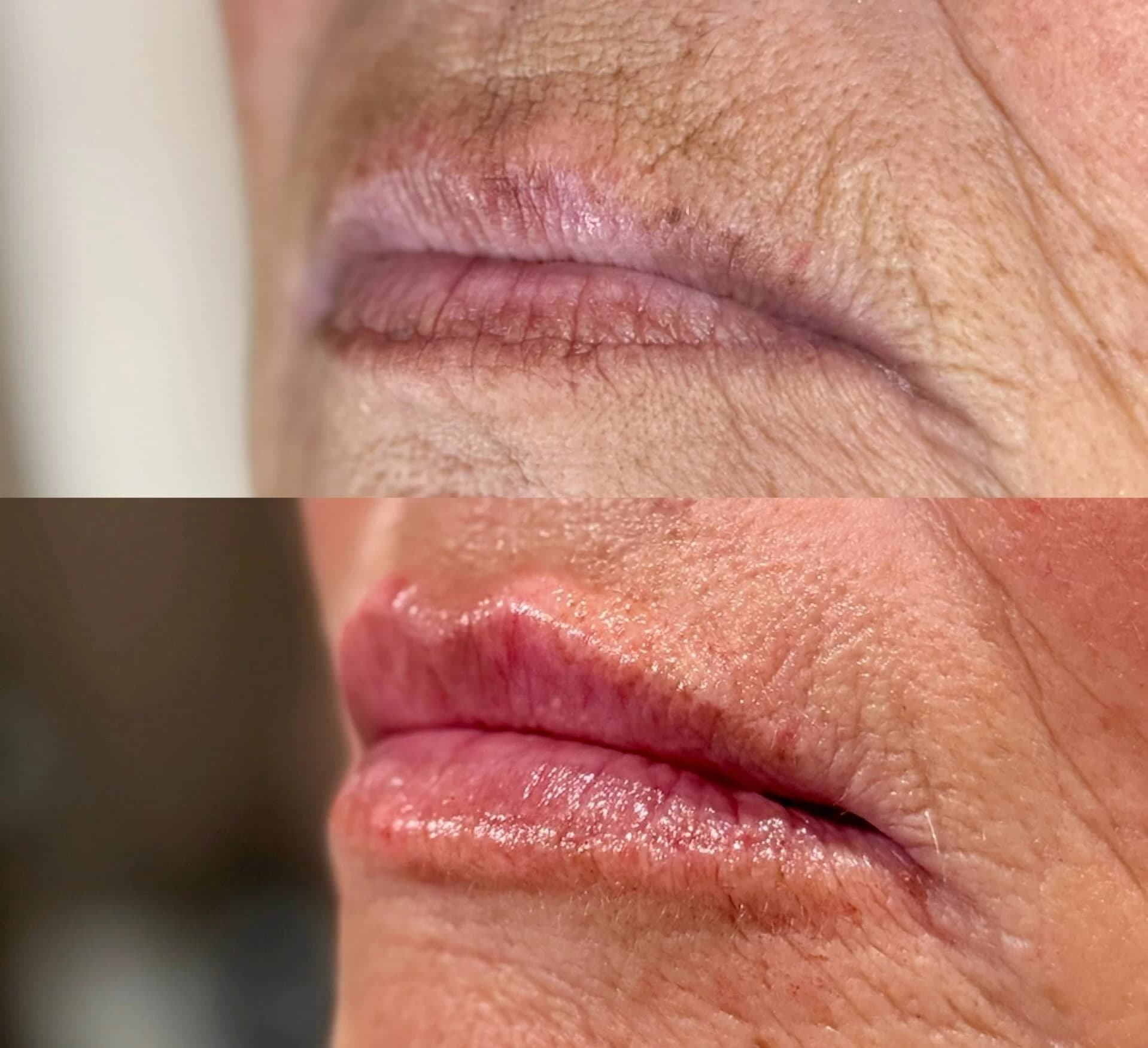 Before and after: Close-up of the lips, before on top and after below, lip filler