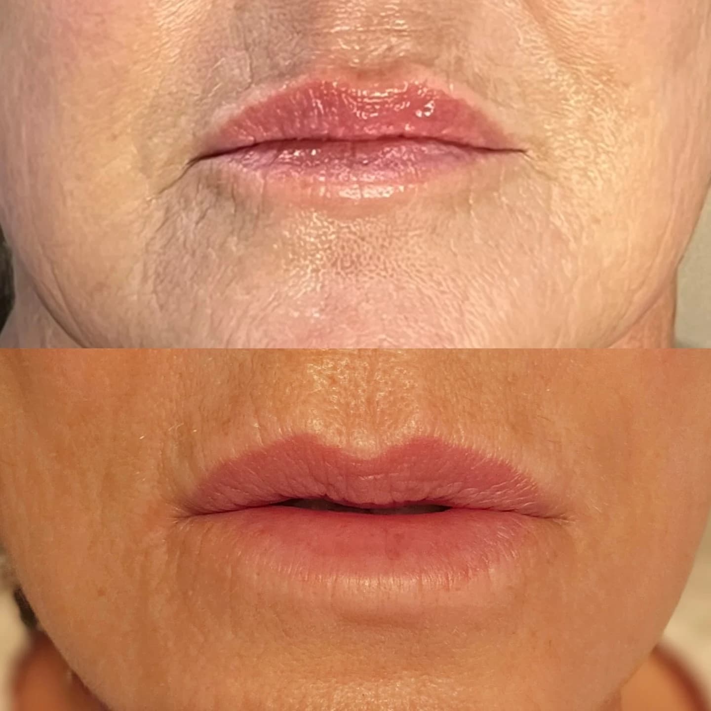 Before and after: Mouth and chin, before on top and after below, lip filler