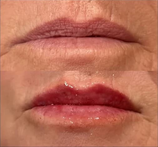 Before and after: Lips, before on top and after below, lip filler