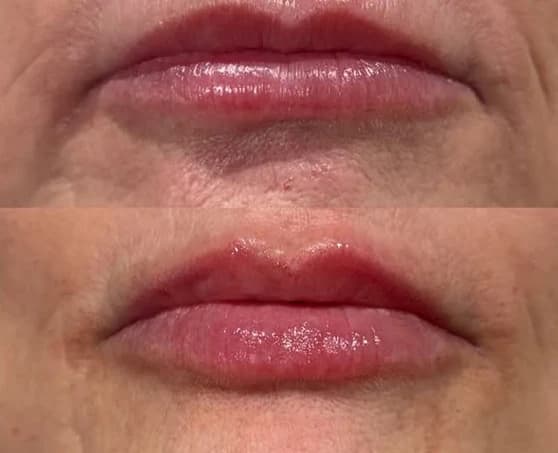 Before and after: Lips, before on top and after below, lip filler