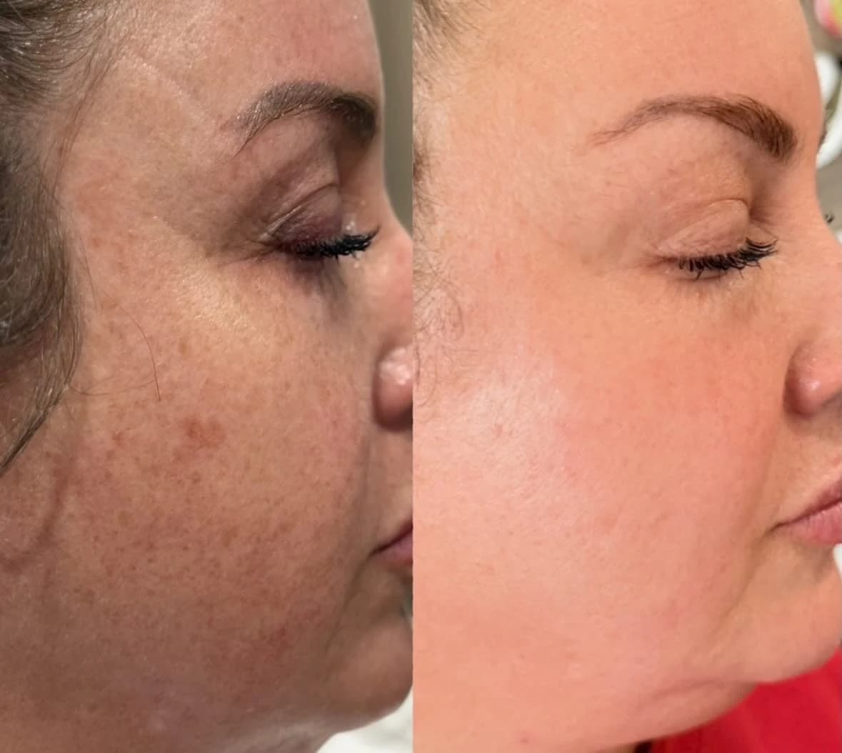 Before and after: Cheek and jaw in profile, before left and after right, NouvaDerm laser