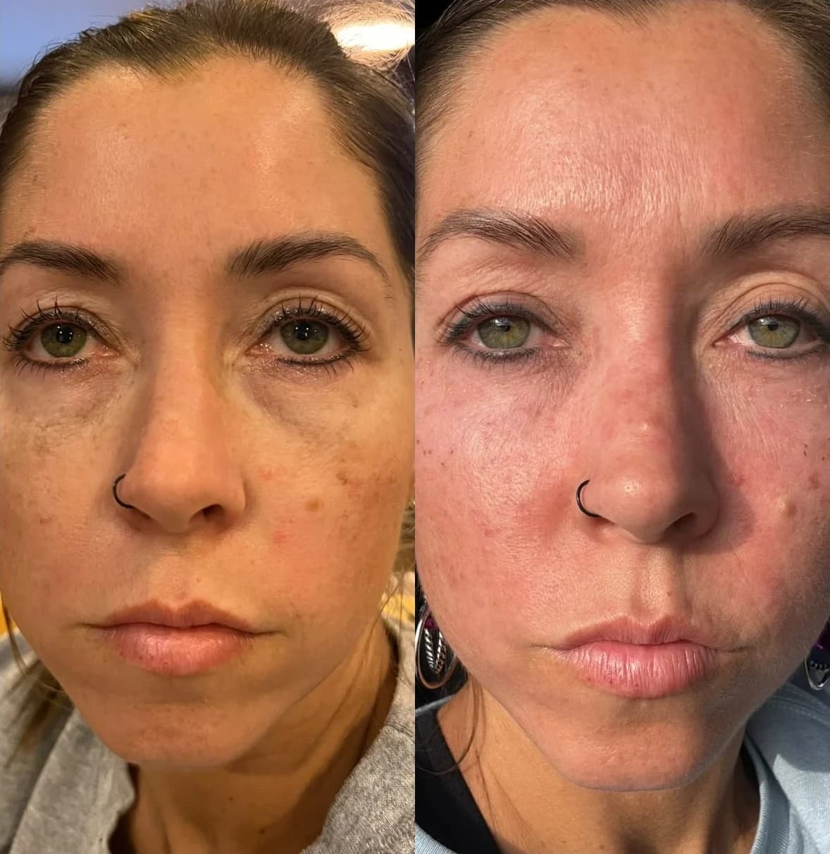 Before and after: plasma pen at Just Face It