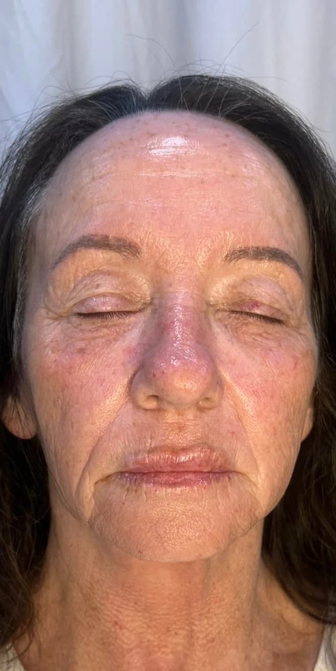 After: Full face, eyes closed, before and after biostimulator filler