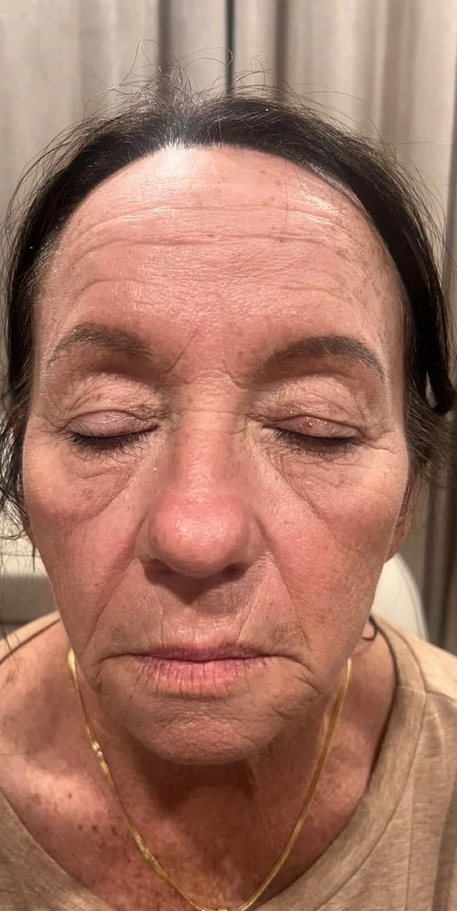 Before: Full face, eyes closed, before and after biostimulator filler