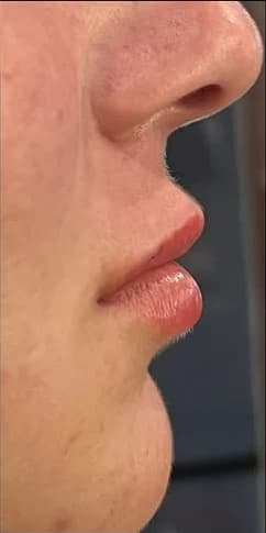 After: Lips in profile, before and after lip filler