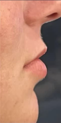 Before: Lips in profile, before and after lip filler