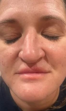 After: Full face, eyes closed, before and after NouvaDerm laser