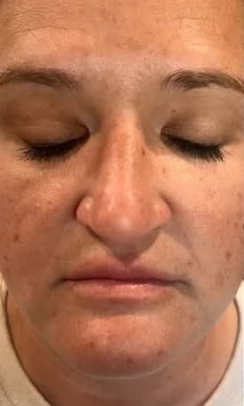 Before: Full face, eyes closed, before and after NouvaDerm laser