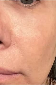 After: Cheek and under-eye, before and after one NouvaDerm treatment