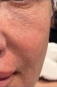 Before: Cheek and under-eye, before and after one NouvaDerm treatment