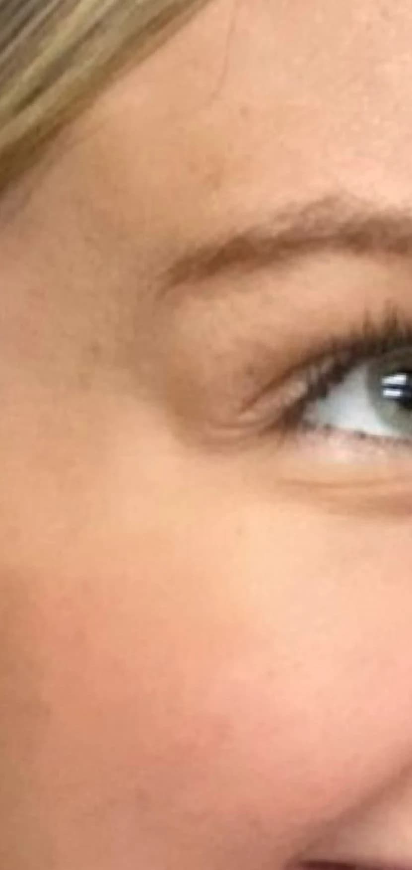 After: Eye and cheek, before and after tox for crow's feet