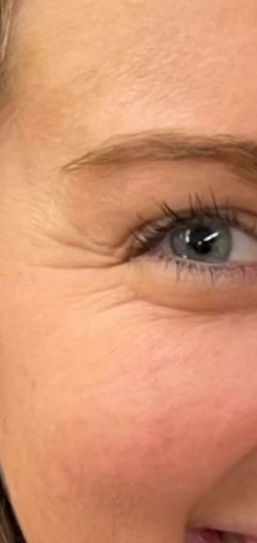 Before: Eye and cheek, before and after tox for crow's feet