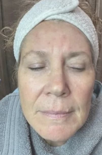 After: Full face, eyes closed, before and after Ultherapy