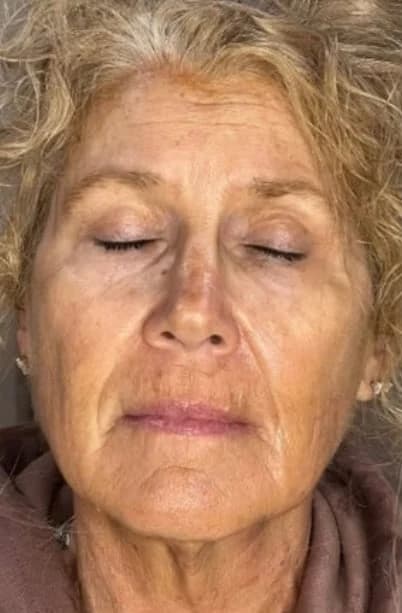 Before: Full face, eyes closed, before and after Ultherapy