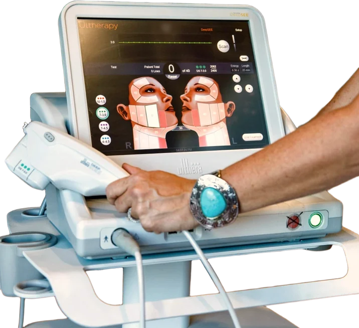 Steph's hand on the Ultherapy handpiece, the DeepSEE face map on the screen