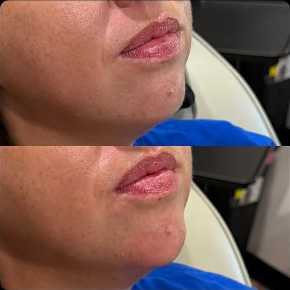 Before and after, top and bottom: a more defined chin and jaw profile after chin filler by Steph