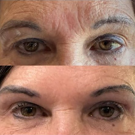 Before and after, top and bottom: smoother forehead and eye area after laser and tox by Grace
