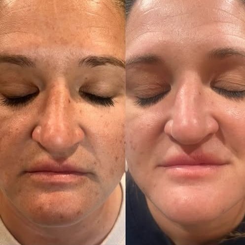 Before and after, side by side: redness and uneven tone calmer after a Nouvaderm laser treatment