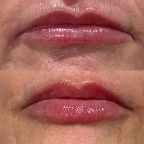 Before and after, top and bottom: fuller, more even lips after lip filler by Grace